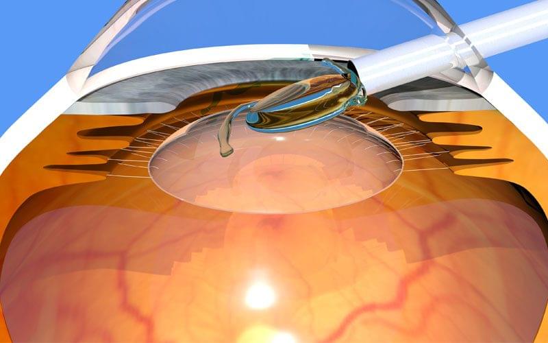cataract surgery