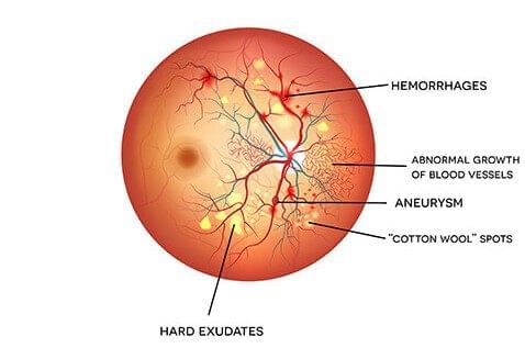 diabetic retinopathy