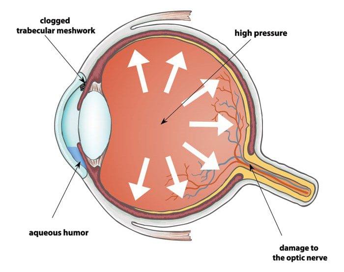 glaucoma