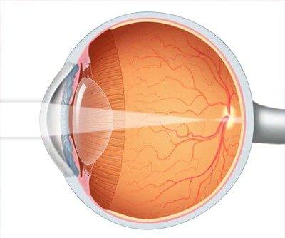 myopia