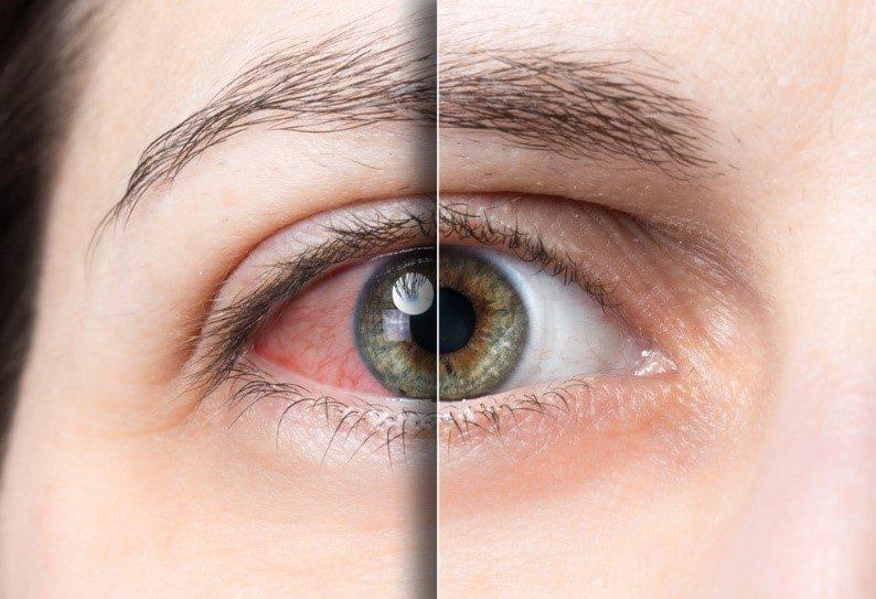 Cornea and Ocular